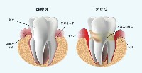 牙齿的沉默杀手——牙周炎！