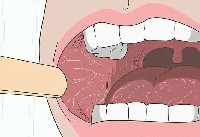 口腔里的白色纹路：带你认识口腔扁平苔藓！