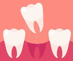 拔牙后多长时间镶牙最好？